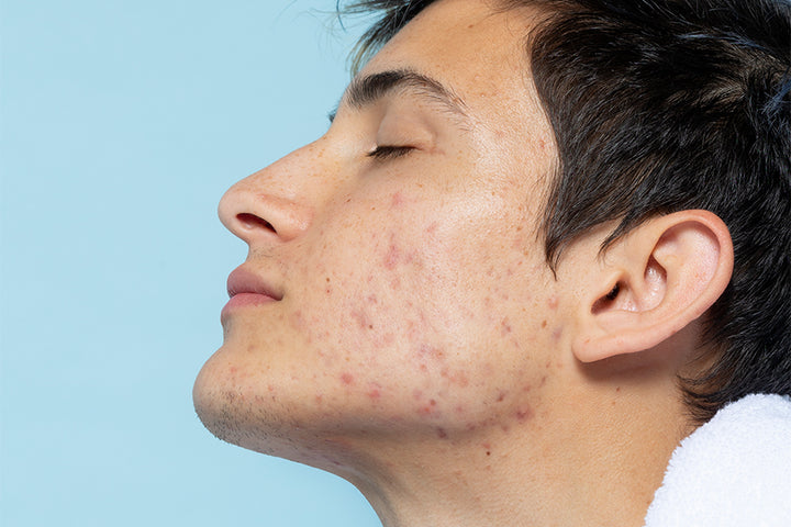 Causes & Treatment for Acne 