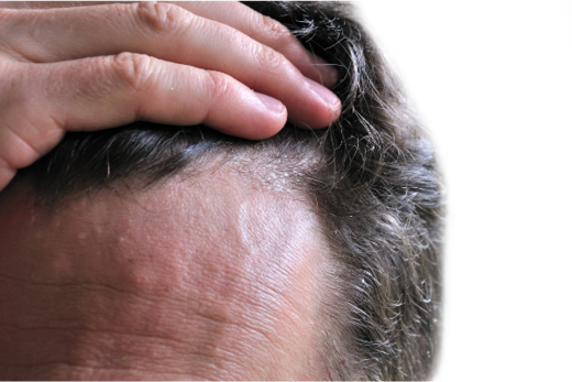 Seborrheic Dermatitis Hair Loss