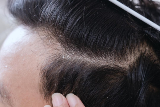 Hair Mask For Dandruff