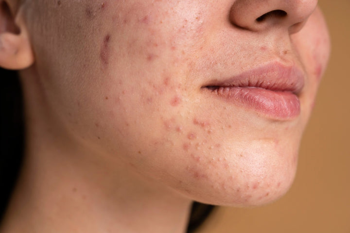 Hyperpigmentation Acne